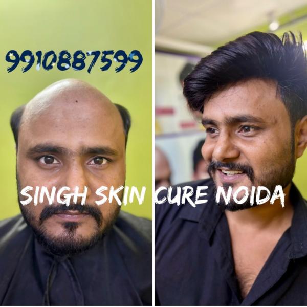 Hair Patch Service in Noida with best de