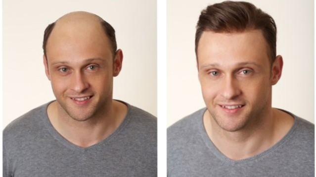 Best Hair Wig Clinic in Delhi 