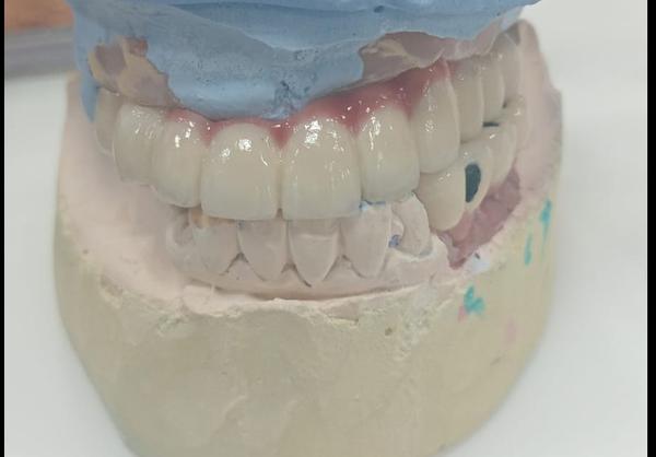 CAD-CAM Crowns – Faster and More Accurate Restorations | PROCARE DENTAL ...