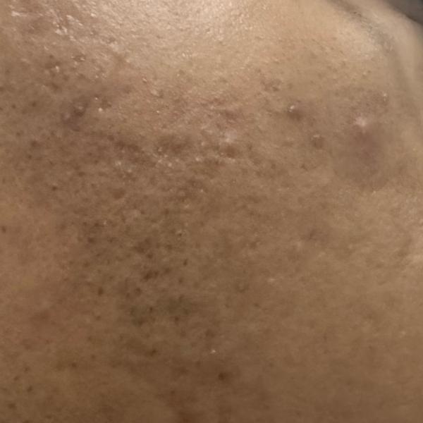 best acne doctor trichy