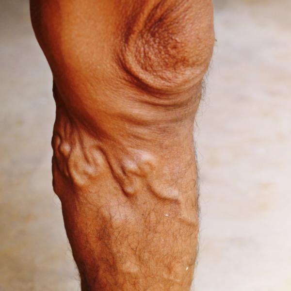 faster recovery after gallblad