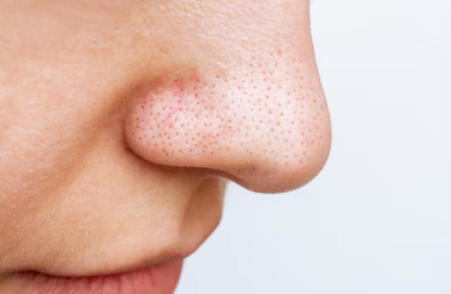 Open pores can be a common con