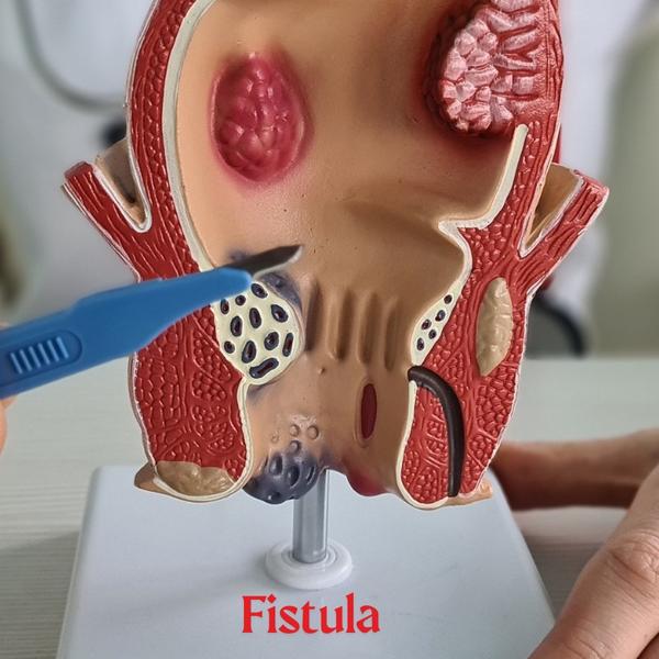 piles surgery consultation san