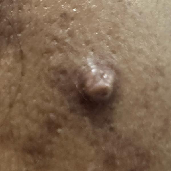best wart removal treatment