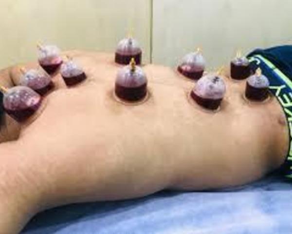 What is Wet Cupping (Hijama)
Wet Cupping