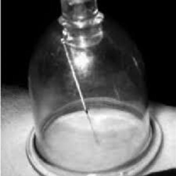 What is Needle Cupping Needle Cupping is