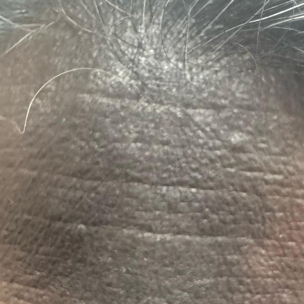 skin doctor in trichy 2 eczema