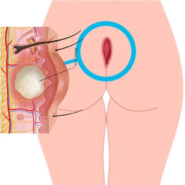 Painful swelling near the tail