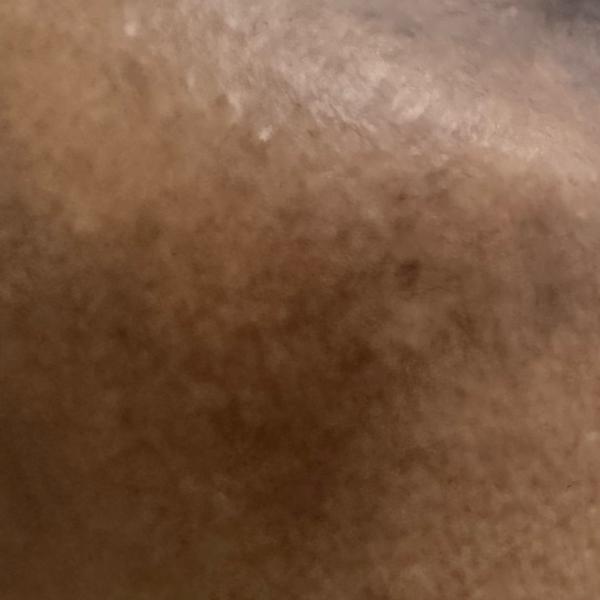 melasma treatment in trichy