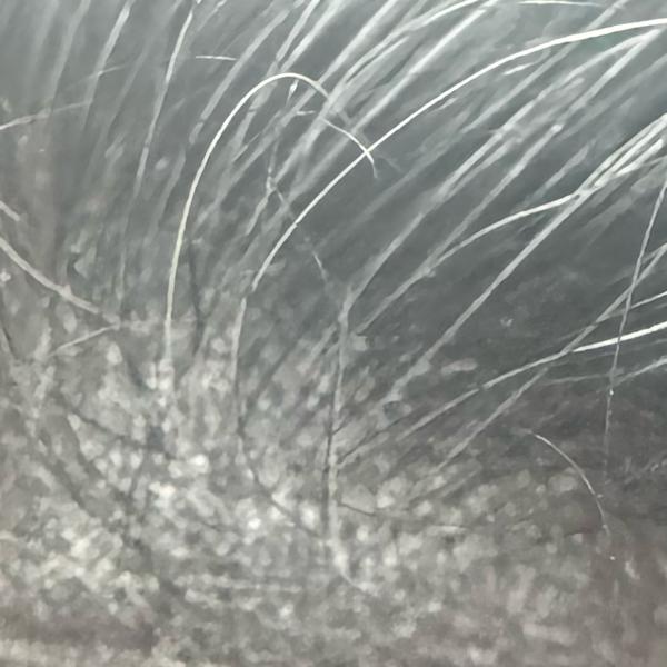 dandruff treatment specialist 