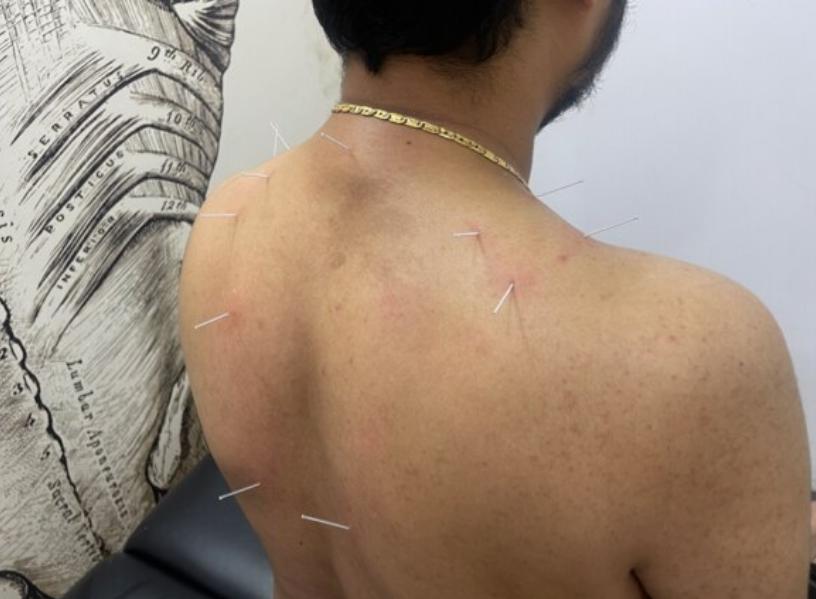 physiotherapy for muscle stiff