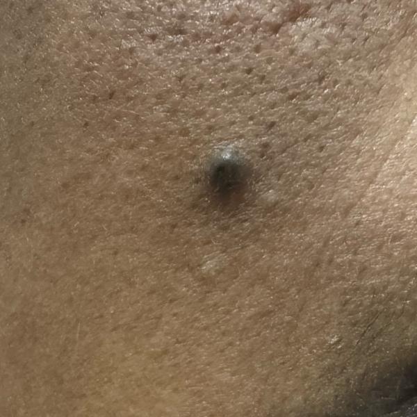 cyst removal in trichy