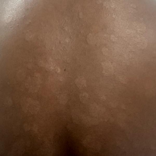 fungal infection doctor near m