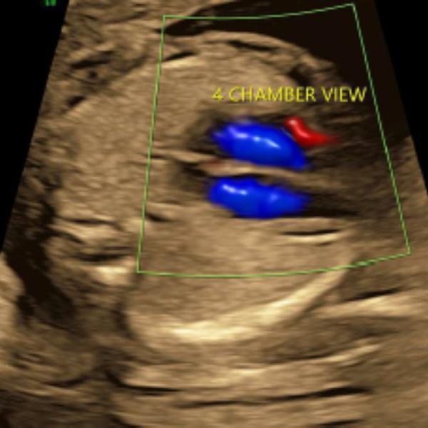 advanced fetal echo rohini del