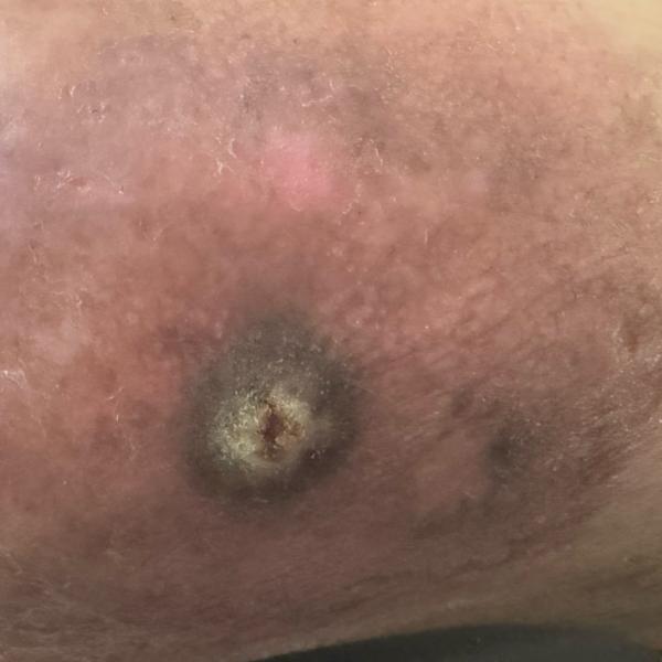 fungal infection doctor near m