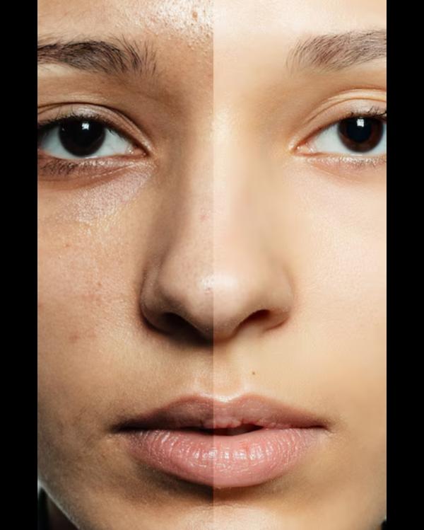 Skin lightening treatment ofte