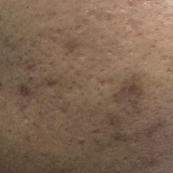 acne treatment specialist in t