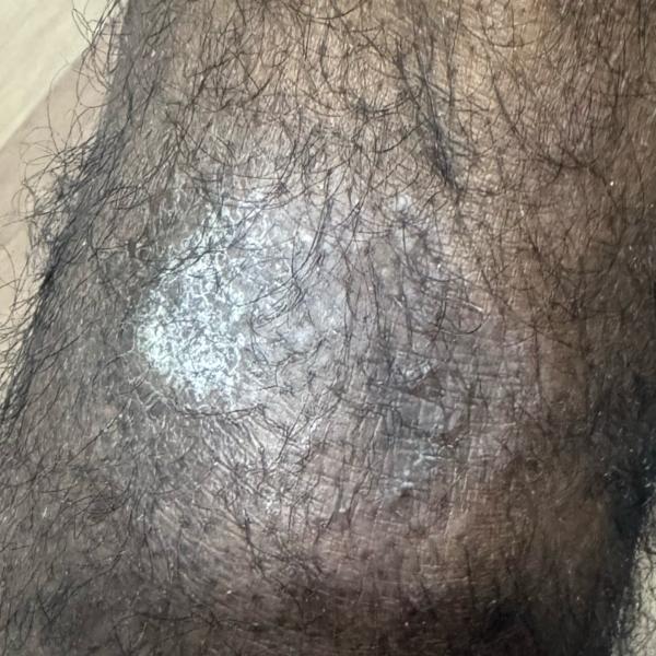 psoriasis treatment near me