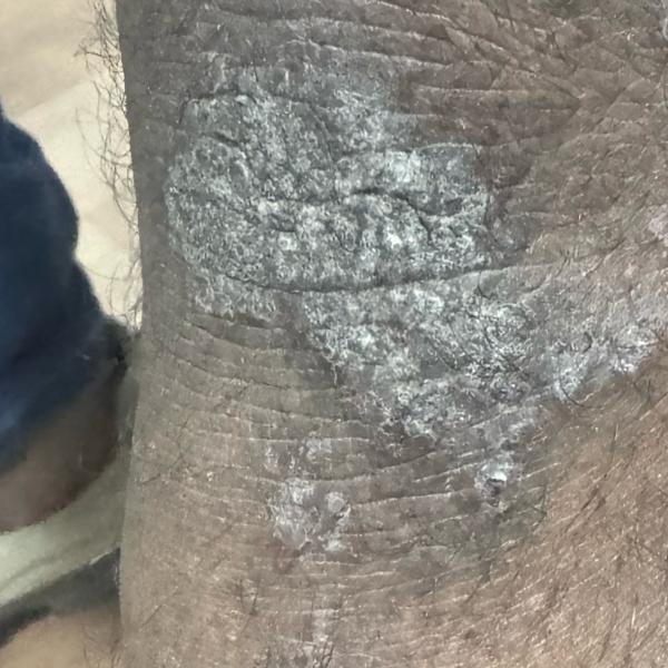 psoriasis and skin allergy tre