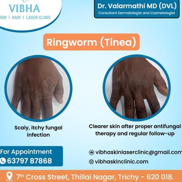 fungal infection doctor near m
