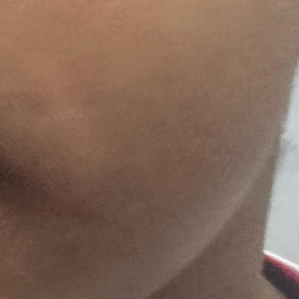 skin doctor in trichy 2 eczema