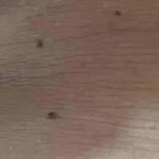 skin tag removal near you
