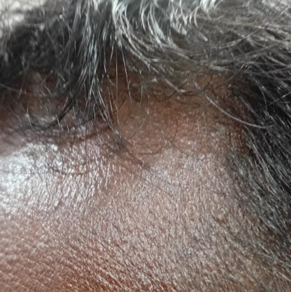 top rated hair fall treatment