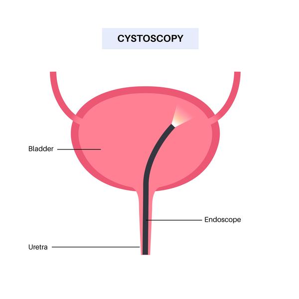 Cystoscopy