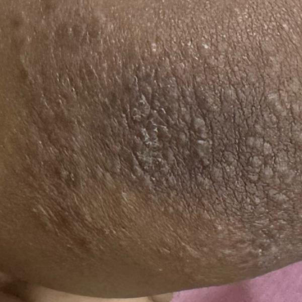 skin diseases treatment trichy