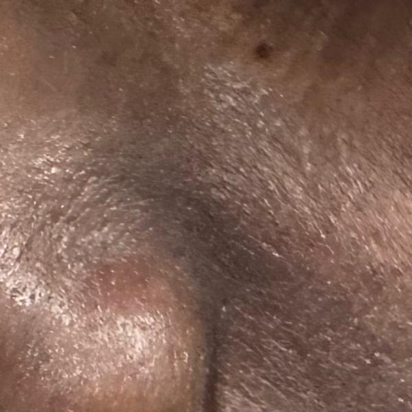 treatment for ringworm in thil