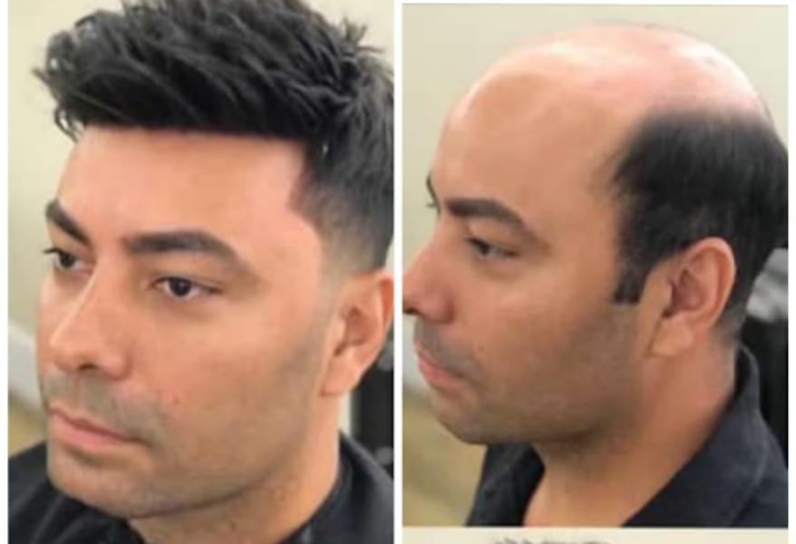 Hair thinning and baldness are common co