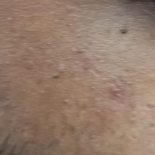 skin tag removal specialist tr