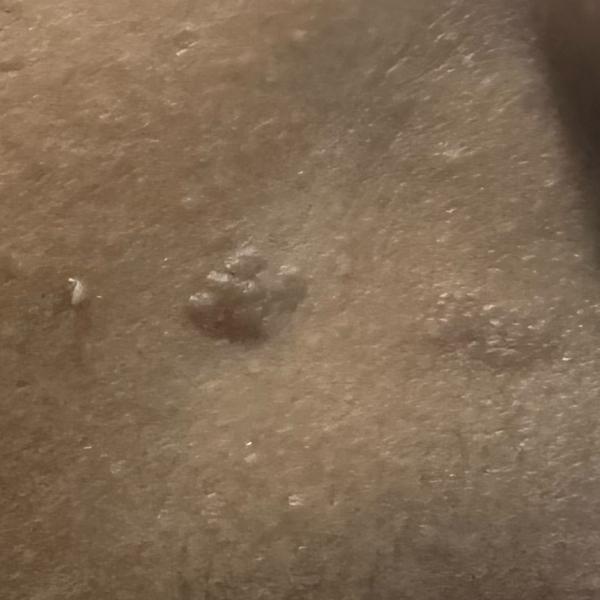 skin tag removal near you
