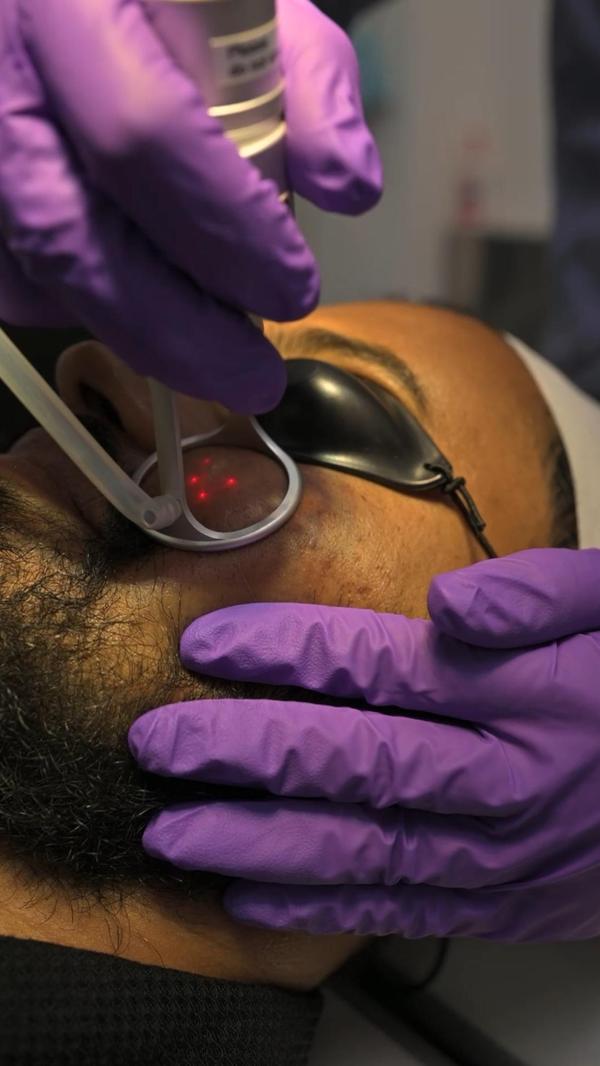 microneedling scalp micro inju