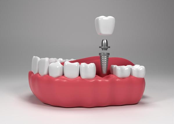 stable long lasting dental imp