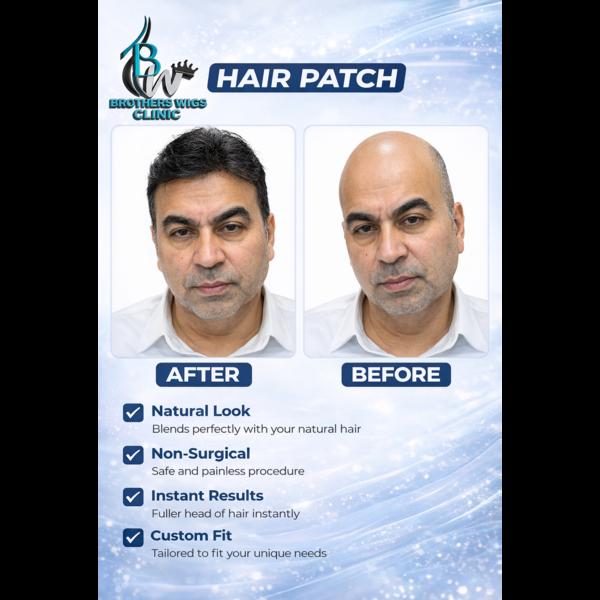 non surgical hair restoration 
