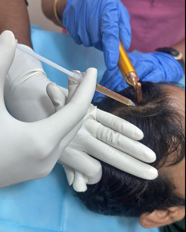 prp hair loss treatment salem
