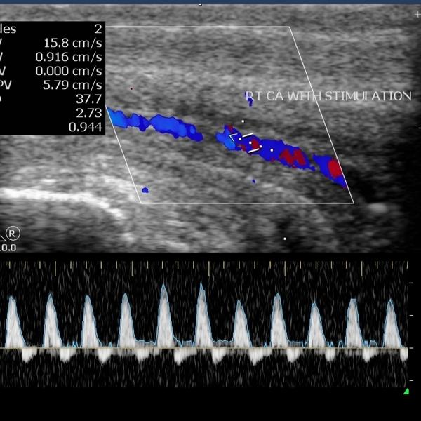 follicular study in rohini
