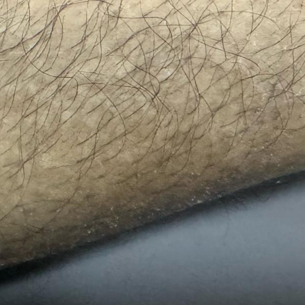 ringworm treatment in trichy