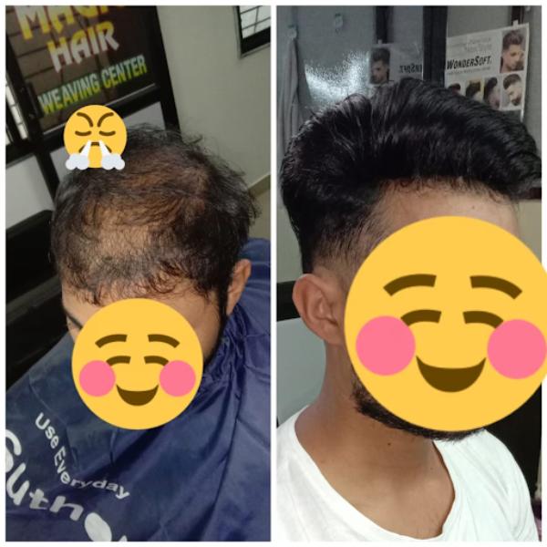 Hair restoration has evolved with techni