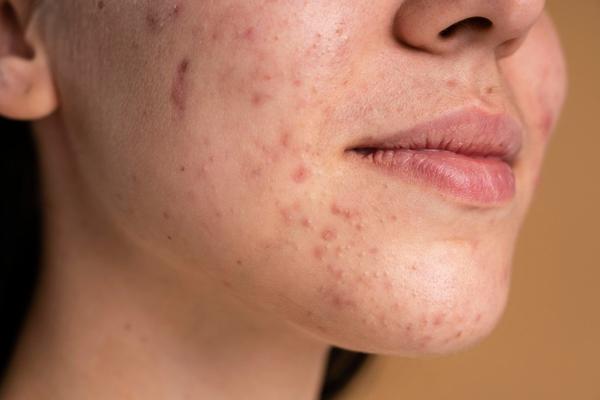 Acne scars can stay long after