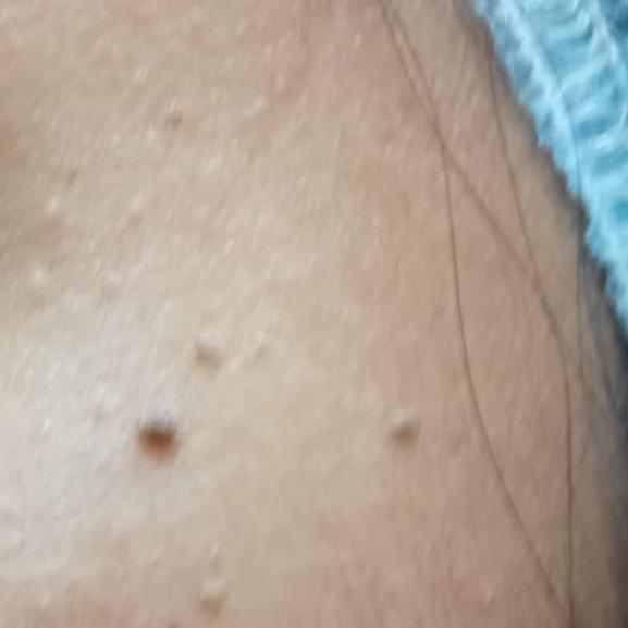 mole wart and skin tag removal