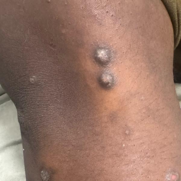 skin diseases treatment trichy