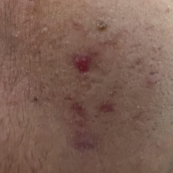 pigmentation removal trichy