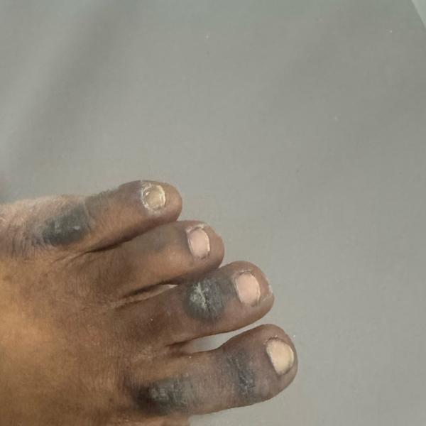 psoriasis treatment near me
