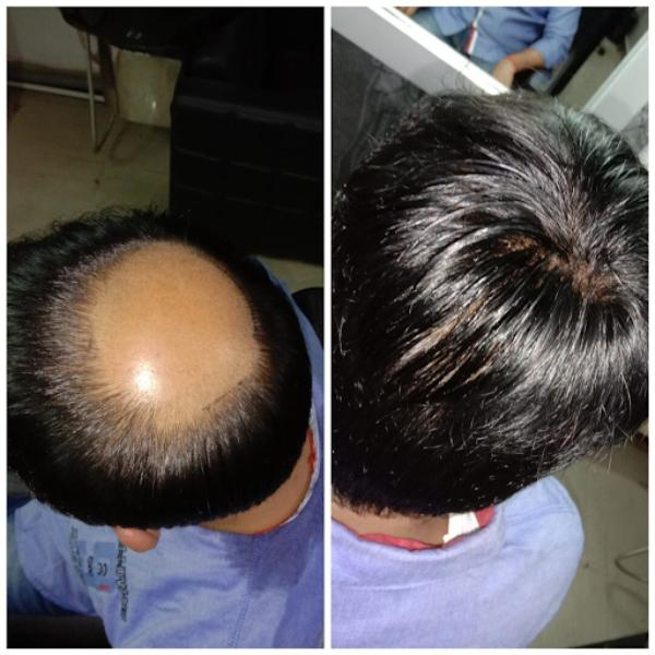 Hair restoration feels most comfortable 