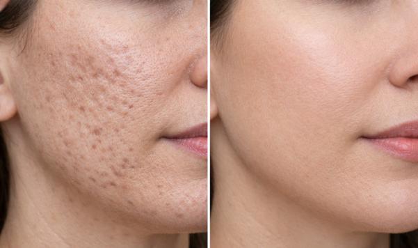 acne scar treatment options ba
