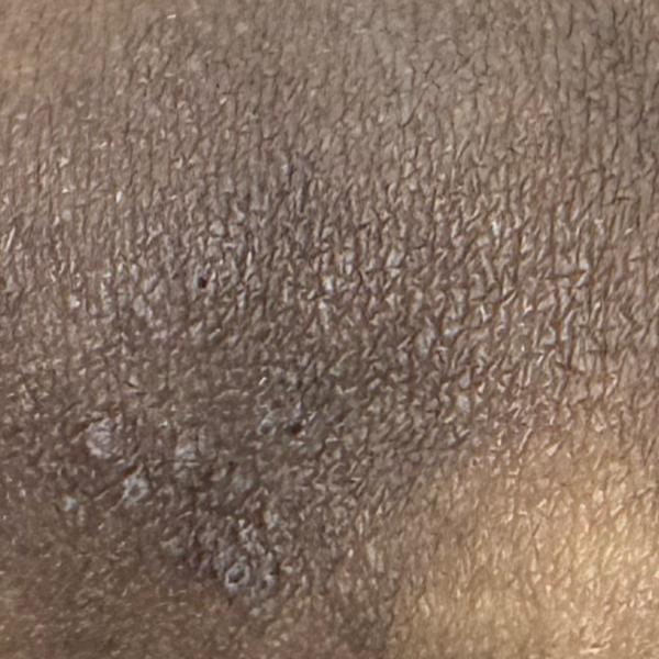 ringworm treatment in trichy