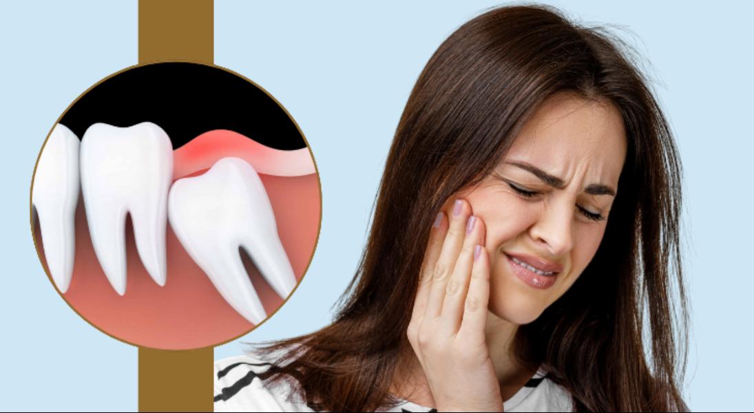 Best Wisdom Tooth Treatment in
