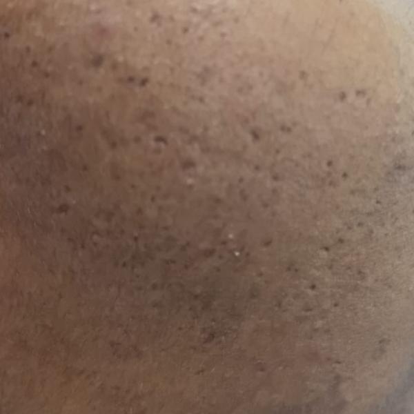 chemical peel dermatologist tr